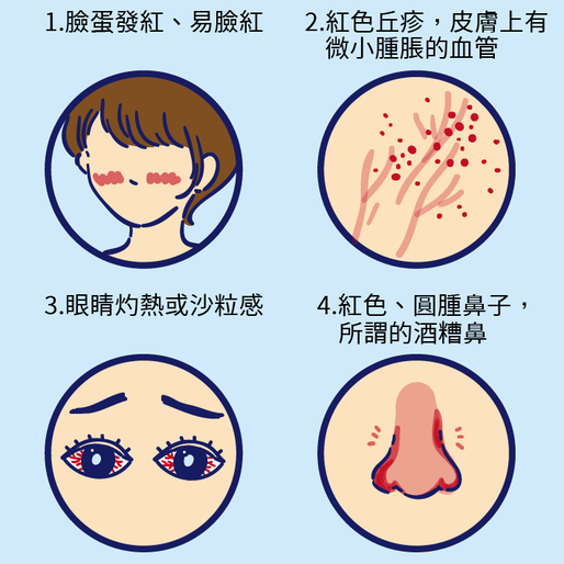 酒糟、脂漏性皮膚炎